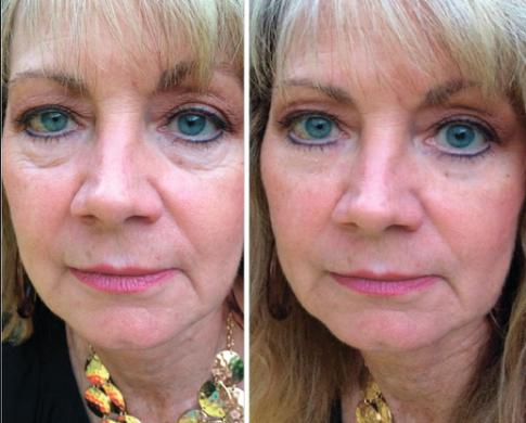 Instantly ageless - Momentinis atjauninimas-1